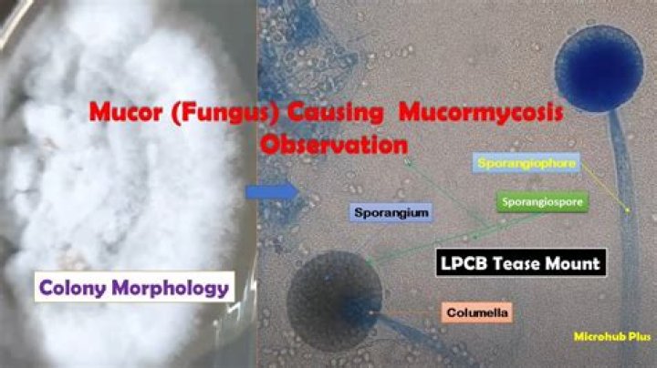When does mucormycosis occurs?