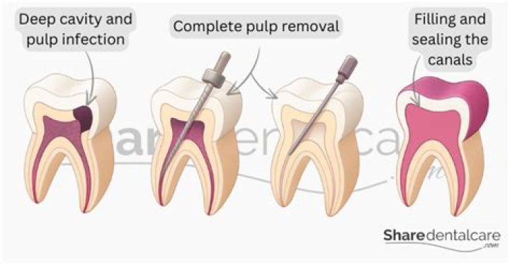 When to do pulpectomy?