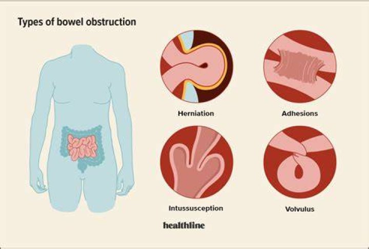 Where do intestinal blockages occur?