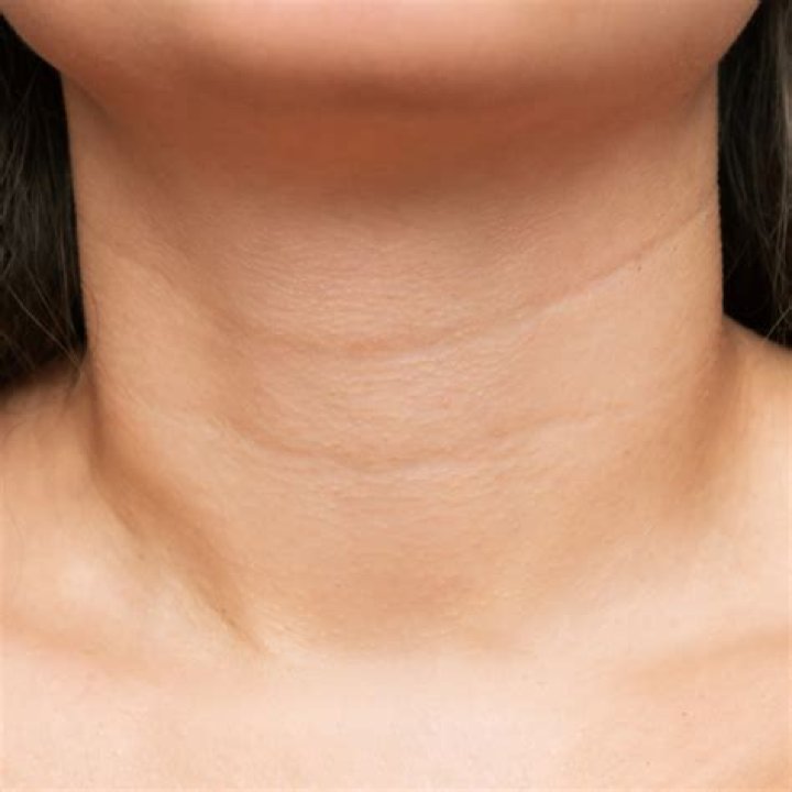 Where do neck creases come from?