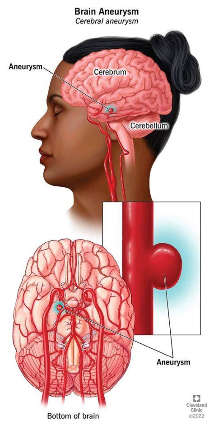 Where does dissecting aneurysm occur?