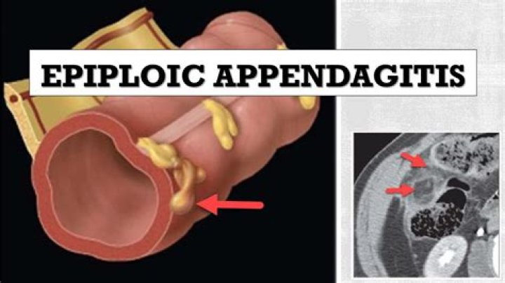 Where does epiploic come from?