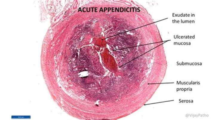 Where is the serositis located?