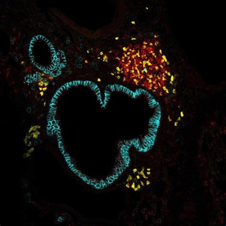 Which lymphomas are indolent?