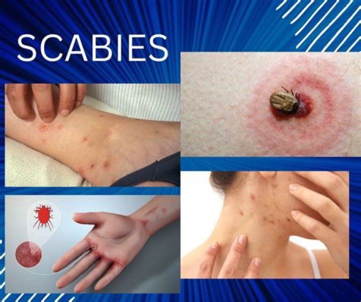Who do you contract scabies?