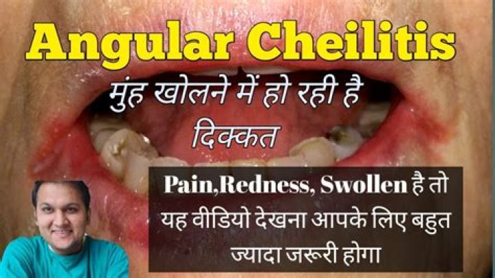 Who gets angular cheilitis?