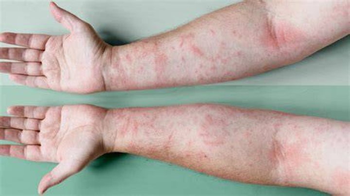 Who gets atopic dermatitis?