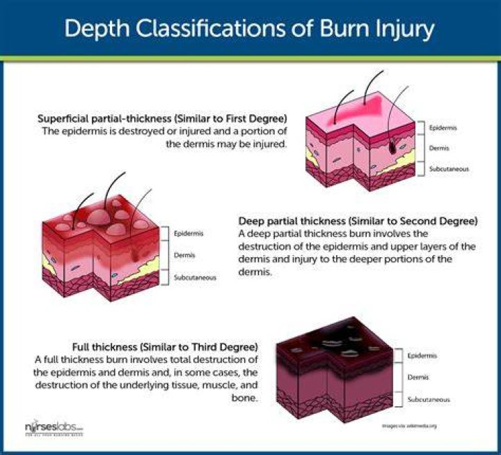 Who is superficial burn?
