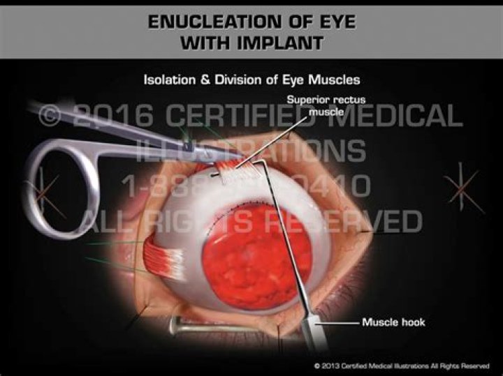 Who performs eye enucleation?