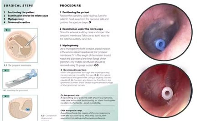 Why are grommets put in ears?