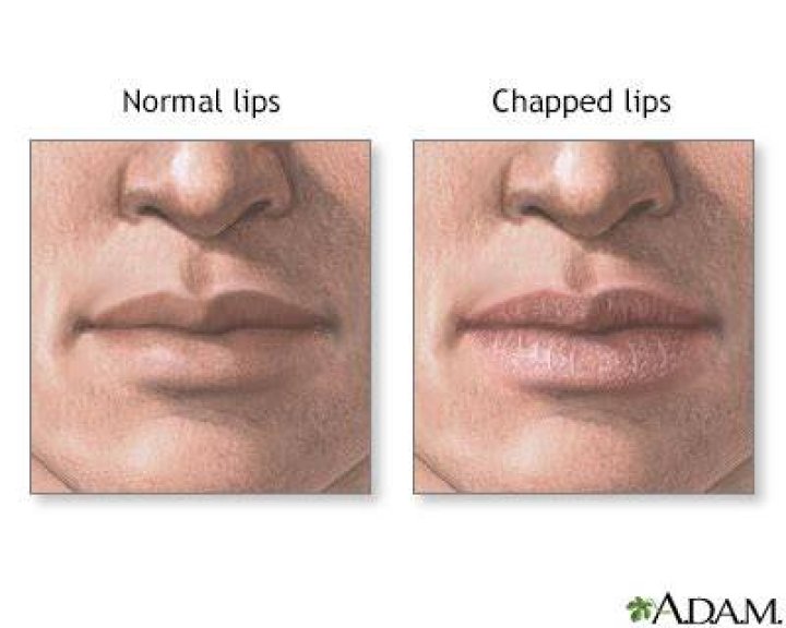 Why are my lips so chapped?