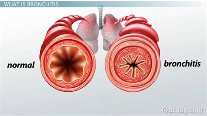 Why bronchitis won't go away?
