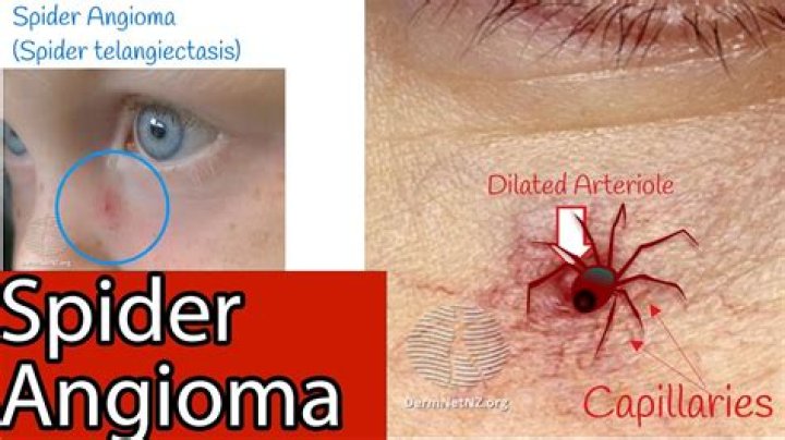 Why do spider angiomas occur?