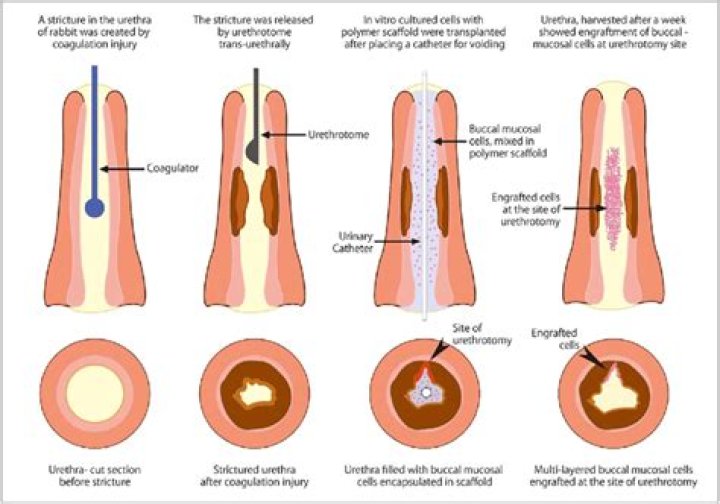 Why do urethral strictures return?