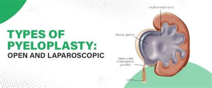 Why is a pyeloplasty done?