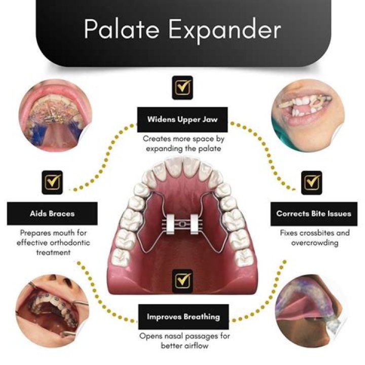 Why is palate soft?
