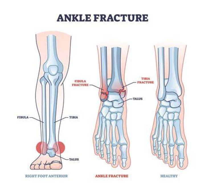 Will a fractured cusp heal?