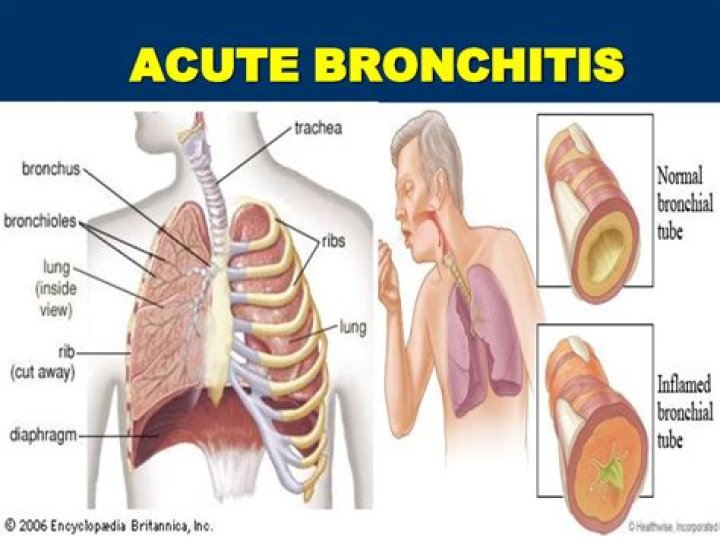 Will bronchitis make you tired?