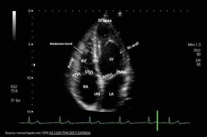 Will echocardiogram show artery blockage?