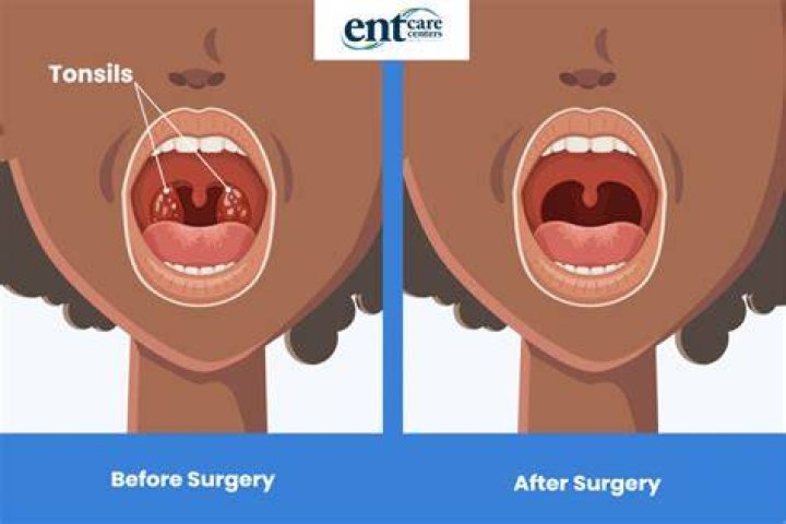 Will removing tonsils help with snoring?