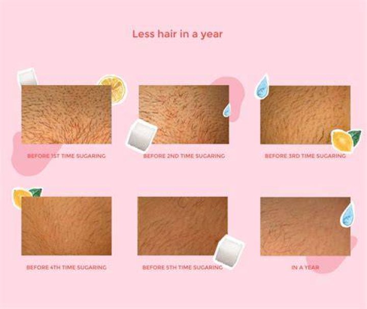 Will sugaring break you out?